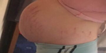 La mamma dà alla luce un neonato dalle dimensioni di un bimbo che fai i primi passi