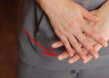 Cosa significano le linee sulle unghie? Come trattare?