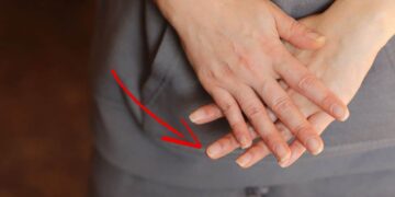 Cosa significano le linee sulle unghie? Come trattare?